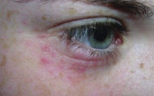 Có nên bôi Retinoids, Retinol vùng da quanh mắt?