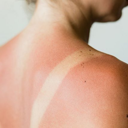 Những cách làm dịu da bị bỏng nắng hiệu quả